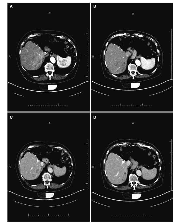 A #ClinicalInvestigation published in 2017: Safety and Efficacy of Y-90 #Radioembolization After Prior Major #Hepatic Resection link.springer.com/article/10.100…