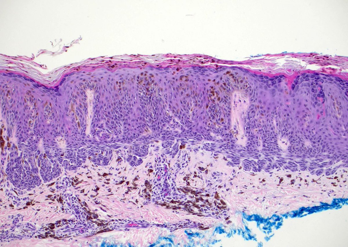 30 yo woman with 5mm circumscribed black papule on the forearm. Your diagnosis? More pics &amp; answer here: kikoxp.com/posts/6880. #pathology #pathologists #pathTwitter #dermpath #dermatology #dermatologia #dermtwitter #USCAP2022