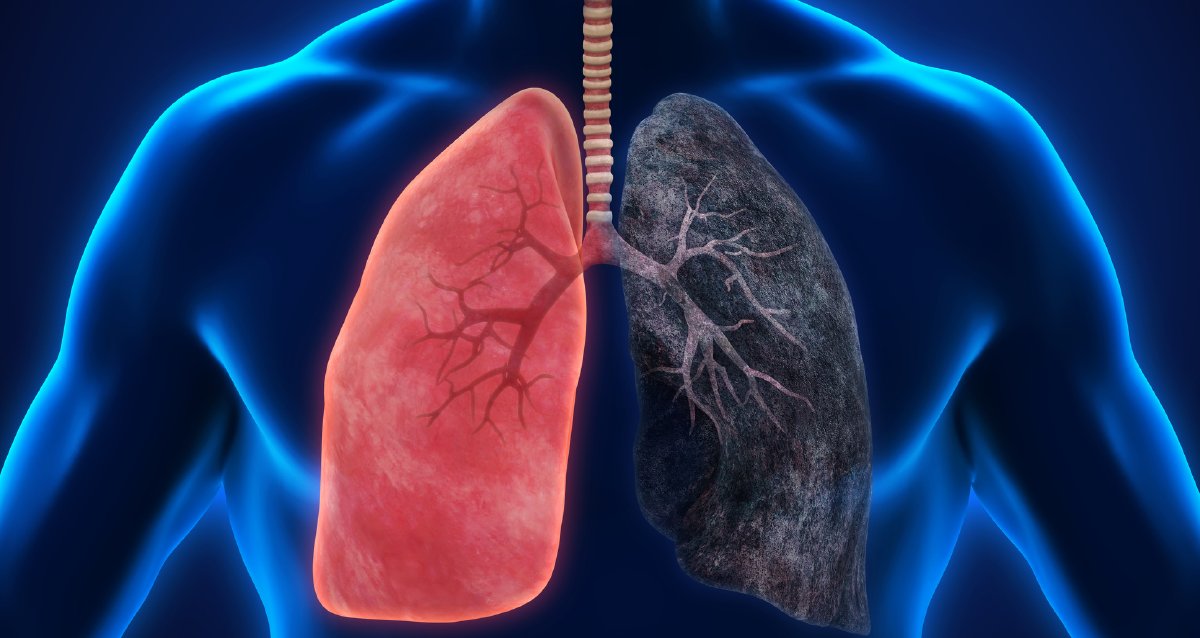 Организм человека легкие. Раковые заболевания легких. Попкорновая болезнь легких. Болезнь легких на фоне. Заболевания органов дыхания.