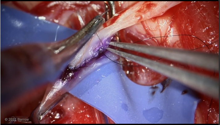 TheJNS's tweet photo. #OperativeVideo Double-barrel STA-MCA bypass and partial trapping of a ruptured mycotic MCA aneurysm with flash fluorescence technique
https://t.co/BurBZj85Zz https://t.co/CdI5nuguKp