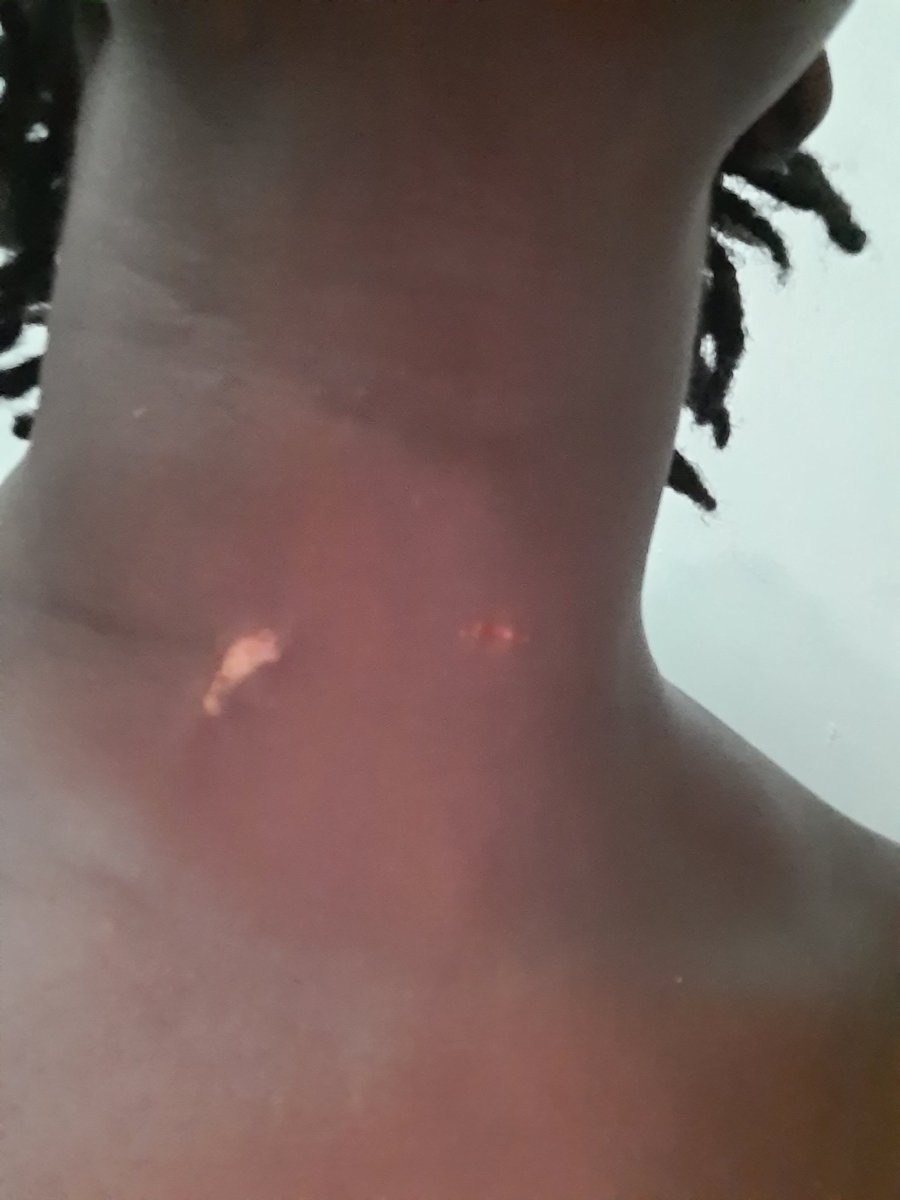 LaduJoy's tweet photo. Haven't had the strength to post here since yesterday's attack by a group of cattle herders shock. 

 Attempts to peacefully talk to them to get the herd from destroying our crops nearly got myself and my staff killed.

Below are injuries that my staff and I sustained. https://t.co/NgL57XfV8M