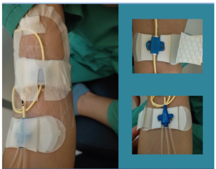BPSOmenorcaIB's tweet photo. Nuevo proyecto #sinsuturas 🛑 trabajando para seguir las recomendaciones! Implantamos sistema de fijación adhesivo para CVCIP/CVC #accesovascular #enfermeriavisible @bpsobalears @asmen_ibsalut @SEINAV_ https://t.co/T3tyj39F5E