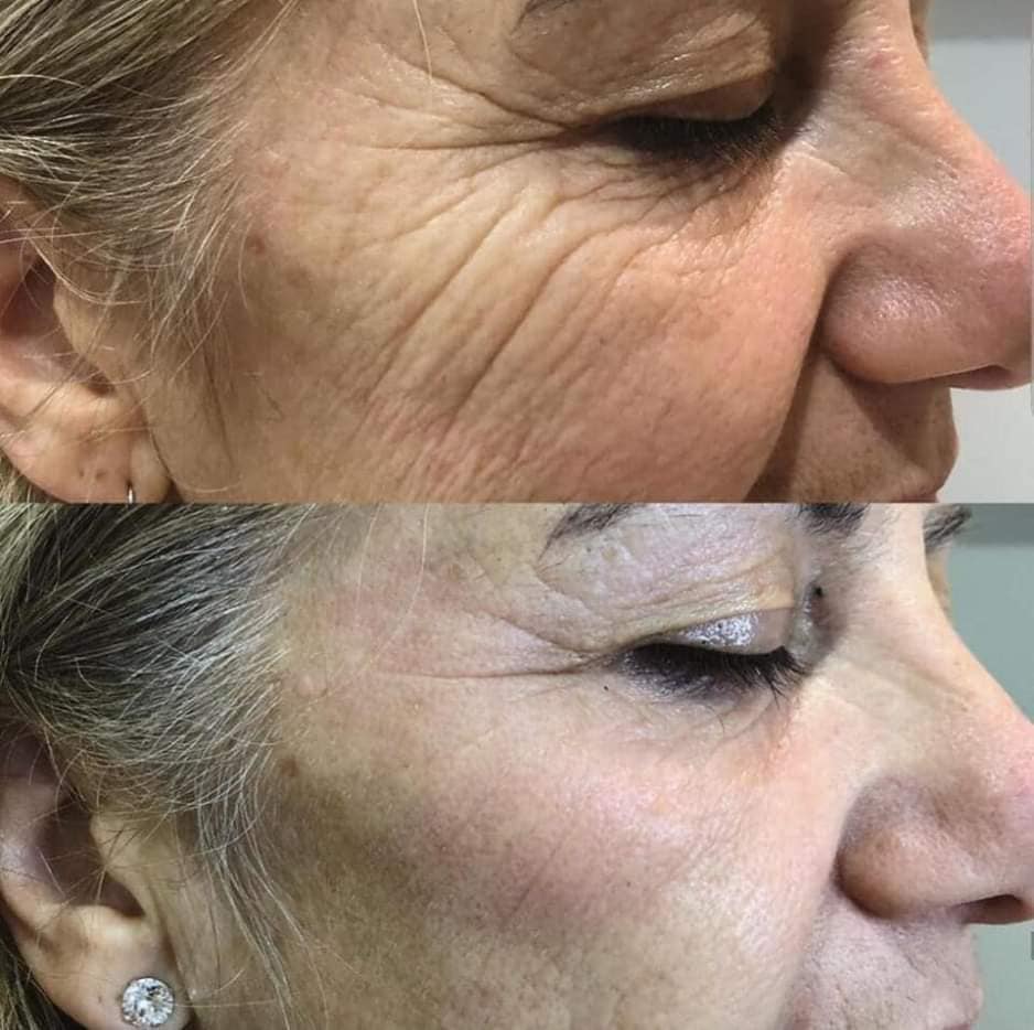 EVALASERTECH's tweet image. WHY 7D HIFU?
7D Ultramage+V max
DOUBLE HANDLE
LIGHTWEIGHT BODY
V-MAX working handle for BODY SHAPING
At lease 20000 shots life span

Wrinkle Removal
Skin Lifting and Tightening
Skin elasticity Improvement 
Body Shaping and contour.
Eyebrows lines lifting
Double Chin Reduction...