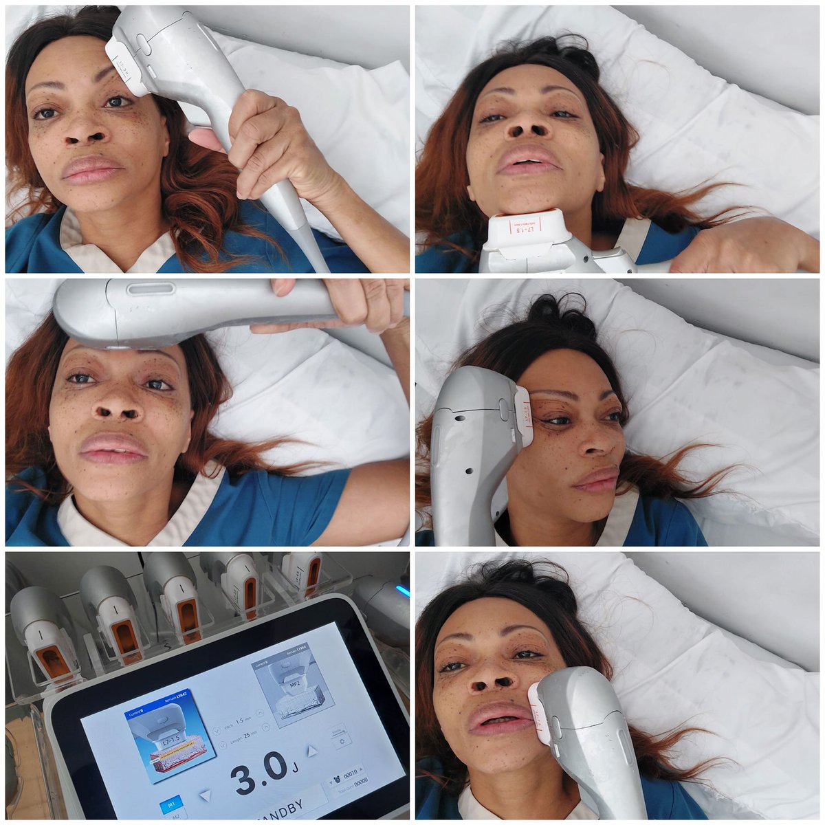 EVALASERTECH's tweet image. WHY 7D HIFU?
7D Ultramage+V max
DOUBLE HANDLE
LIGHTWEIGHT BODY
V-MAX working handle for BODY SHAPING
At lease 20000 shots life span

Wrinkle Removal
Skin Lifting and Tightening
Skin elasticity Improvement 
Body Shaping and contour.
Eyebrows lines lifting
Double Chin Reduction...