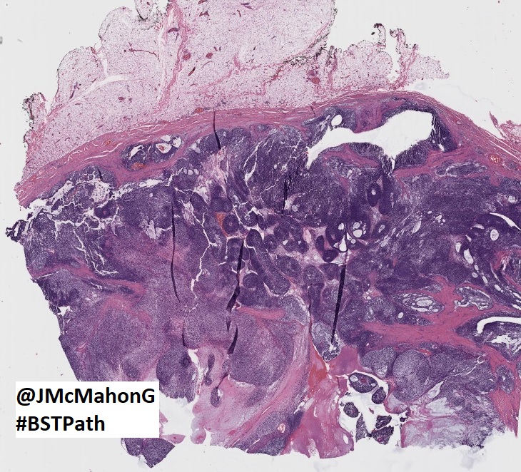 JMcMahonG's tweet photo. #BSTPath101

Wish I was able to attend @TheUSCAP #USCAP2022 AM. 7 week old keeping me in Baltimore this year. 

Will see you next year! 

This from our #BSTPath consultation service

Abdominal wall ST mass, adult. Non-significant PMH

Drinks on me at #USCAP2023 for correct reply! https://t.co/sK2ZgEvx23