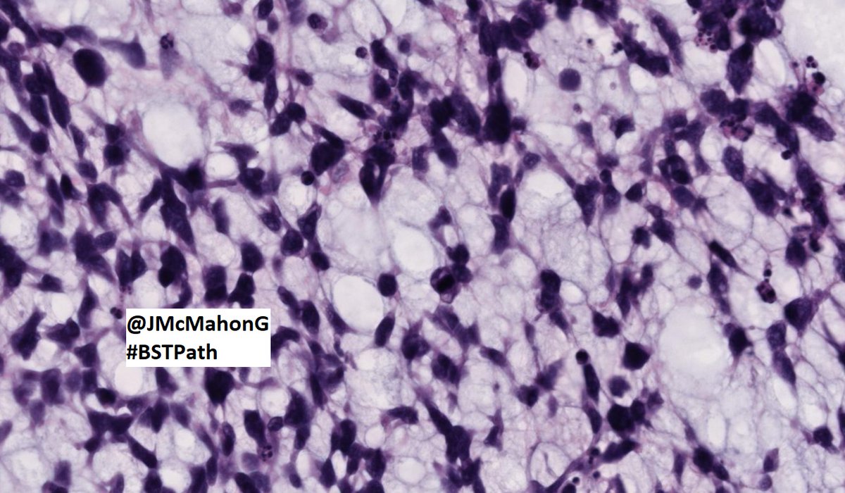 JMcMahonG's tweet photo. #BSTPath101

Wish I was able to attend @TheUSCAP #USCAP2022 AM. 7 week old keeping me in Baltimore this year. 

Will see you next year! 

This from our #BSTPath consultation service

Abdominal wall ST mass, adult. Non-significant PMH

Drinks on me at #USCAP2023 for correct reply! https://t.co/sK2ZgEvx23