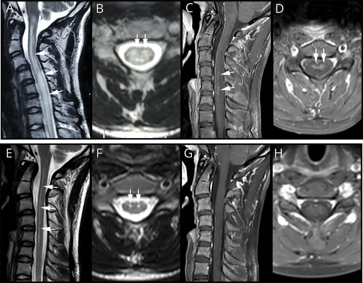 GreenJournal's tweet photo. Teaching #NeuroImage: Leber Hereditary Optic Neuropathy With Longitudinal Spinal Cord Lesion Mimicking Spinal Cord Infarction https://t.co/rjCfGtKofQ #NeuroTwitter #NeurologyRF https://t.co/5ZZcV2yAA9