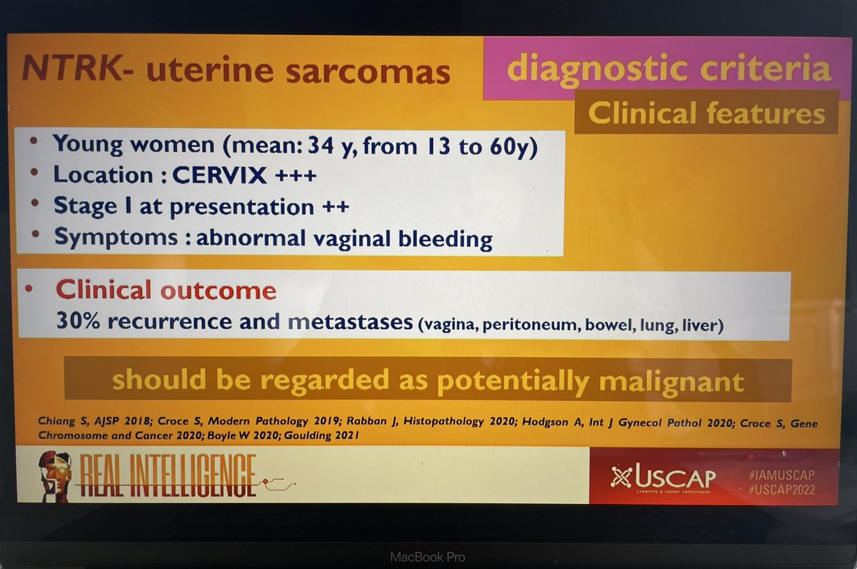 JNStallMD's tweet photo. The final @TheUSCAP @ISGynP presentation is a an update on fibrosarcoma-like uterine sarcomas! @CroceMd gives an elegant overview of NTRK-uterine sarcomas #USCAP2022 #gynpath https://t.co/ffbudRPYLd