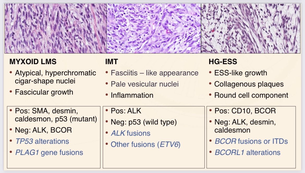 .<a href="/CPHpath/">Carlos Parra-Herran MD</a> reviews the current spectrum of uterine myxoid mesenchymal uterine neoplasms and the WHO criteria for diagnosing entities in the differential <a href="/TheUSCAP/">USCAP</a> <a href="/ISGynP/">International Society of Gynecologic Pathologists</a> companion society meeting! #USCAP2022 #gynpath