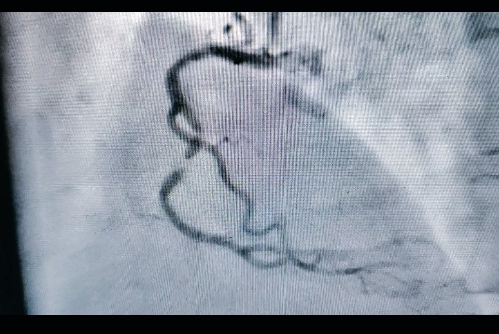 RajeshRajani15's tweet image. Heavily calcified RCA plaque treated with Rotablation in an 80 year old gentleman. No reflow after Rota 1.5 mm burr runs managed successfully with good result #Rotablation #calcifiedcoronary #CardioTwitter #complexcoronary