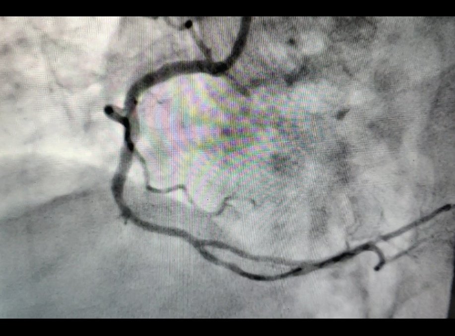 RajeshRajani15's tweet image. Heavily calcified RCA plaque treated with Rotablation in an 80 year old gentleman. No reflow after Rota 1.5 mm burr runs managed successfully with good result #Rotablation #calcifiedcoronary #CardioTwitter #complexcoronary