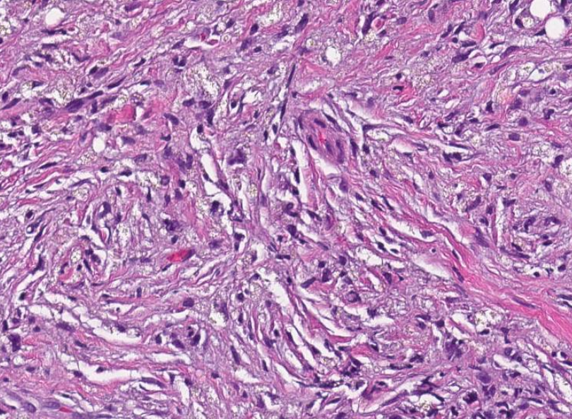 SibaElHussein's tweet photo. Histiocyte-rich pseudotumor in the setting of post lymphoma chemotherapy shown by @ljmedeirosMD & @SkybhatiaMD last week & described here⏩ https://t.co/3BSKu8VzWX @AJSP | revisit slides https://t.co/hlXL3FpQGX (case 1) | notes https://t.co/fpNtIjLfoj #hemepath #pathtwitter #lyms https://t.co/0j2FuStsht