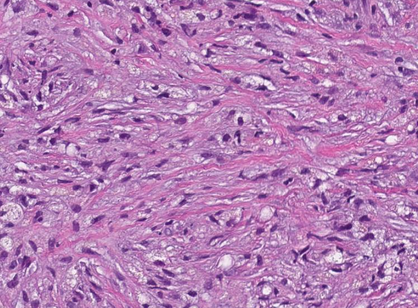 SibaElHussein's tweet photo. Histiocyte-rich pseudotumor in the setting of post lymphoma chemotherapy shown by @ljmedeirosMD & @SkybhatiaMD last week & described here⏩ https://t.co/3BSKu8VzWX @AJSP | revisit slides https://t.co/hlXL3FpQGX (case 1) | notes https://t.co/fpNtIjLfoj #hemepath #pathtwitter #lyms https://t.co/0j2FuStsht