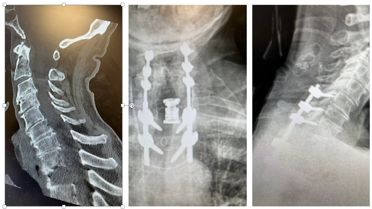 DrSamadani's tweet photo. Best part is when one of my nieces said to the other "you have be careful reaching around the spinal cord when the tumor is in front..." #overheardconversations https://t.co/KDKVblB5ZO