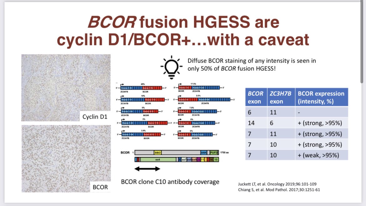 Jennifer N Stall, MD (@jnstallmd) on Twitter photo DrSChiang discusses high grade endometrial stromal sarcomas. Remember - If you have a myxoid spindle cell tumor of the uterus that is desmin negative - be sure to include BCOR fusion HGESS in the differential! <a href="/ISGynP/">International Society of Gynecologic Pathologists</a> #USCAP2022 #gynpath DrSChiang discusses high grade endometrial stromal sarcomas. Remember - If you have a myxoid spindle cell tumor of the uterus that is desmin negative - be sure to include BCOR fusion HGESS in the differential! <a href="/ISGynP/">International Society of Gynecologic Pathologists</a> #USCAP2022 #gynpath