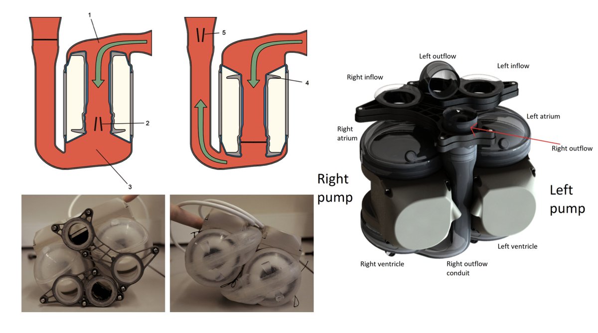 ArtifOrgans's tweet photo. #Hemodynamic #Characterization of the #Realheart® total #ArtificialHeart with a hybrid #Cardiovascular #Simulator
#OnlineFirst👉https://t.co/i55fXmWEnh
@LeuvenResearch🇮🇹| @NilsBrynedal #MockLoop #CardiovascularModeling #Output https://t.co/m22JqDmcKU