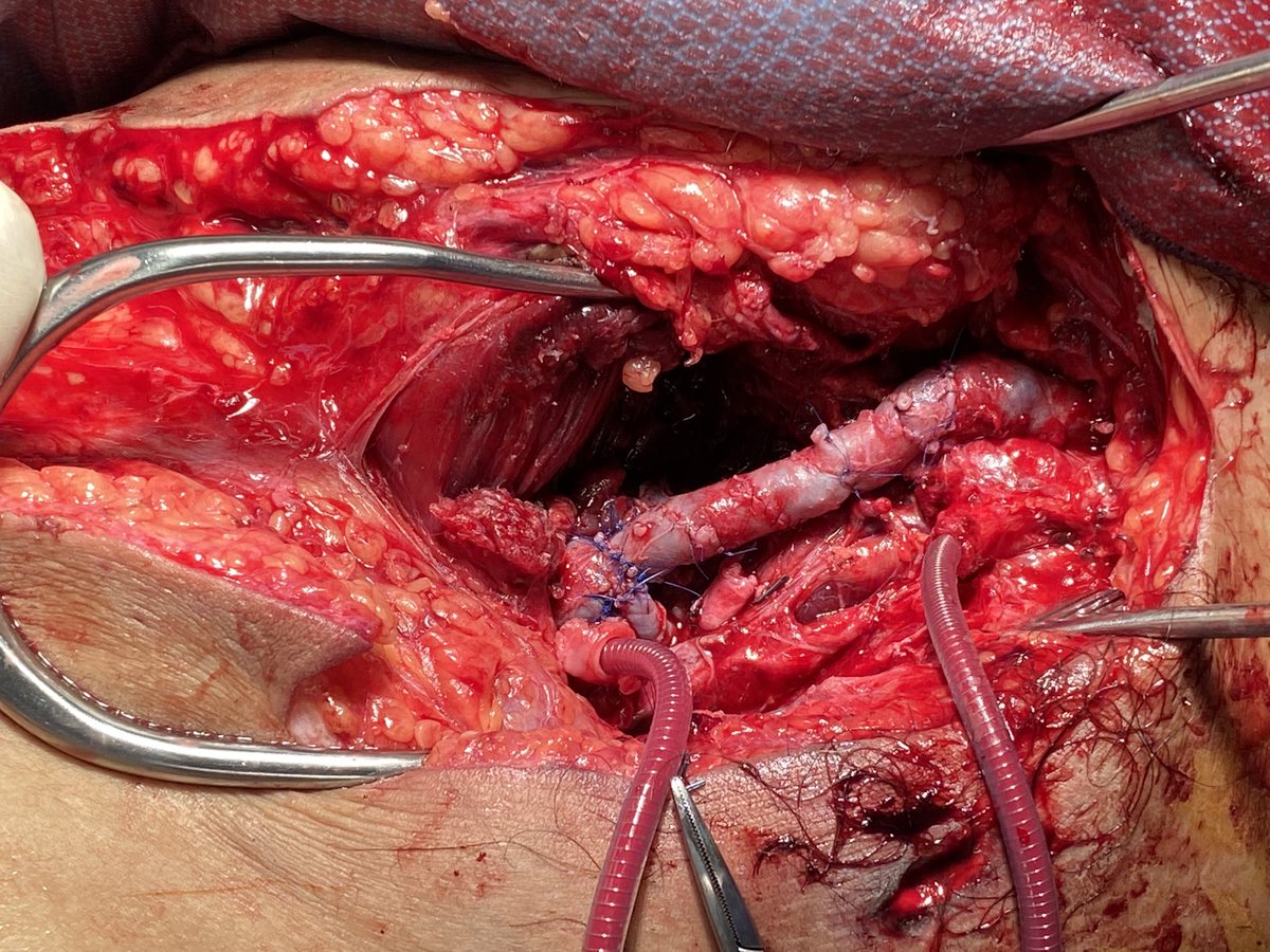mnooromid's tweet photo. Chest tubes have more than one use. Blown out CFA/SFA/PFA and CFV/FV/PFV. #vasctwitter #MedTwitter #MedEd #Trauma #spiralvein #ihavethebestjob #jeffersonsurgery https://t.co/CMdhr6c2FW