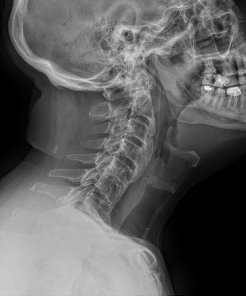 Q: 75yo male with neck pain and stiffness. What is this appearance called?
ANSWER: radiopaedia.org/cases/98077
#FOAMrad #FOAMed