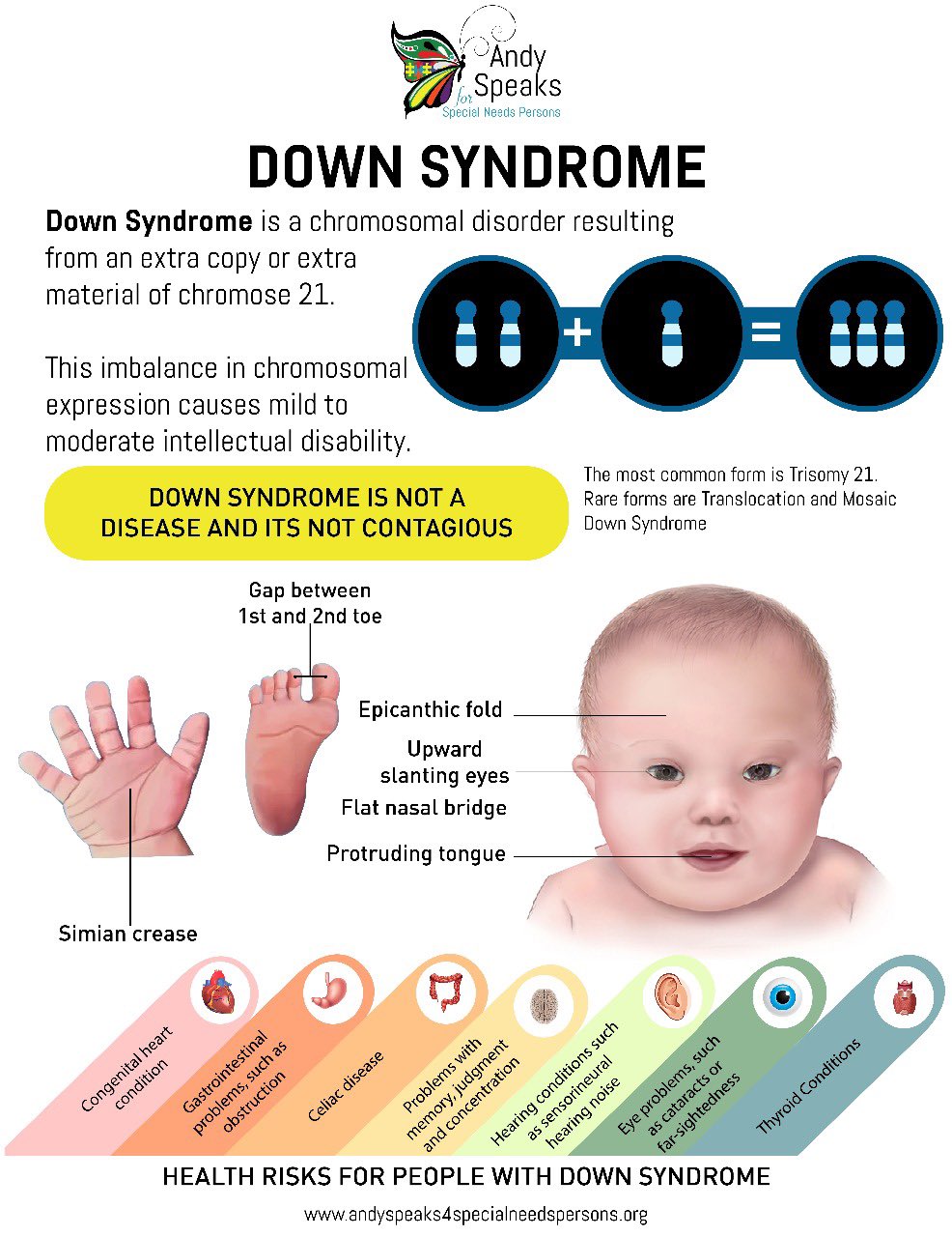 People With Translocation Down Syndrome people-with-translocation-down-syndrome