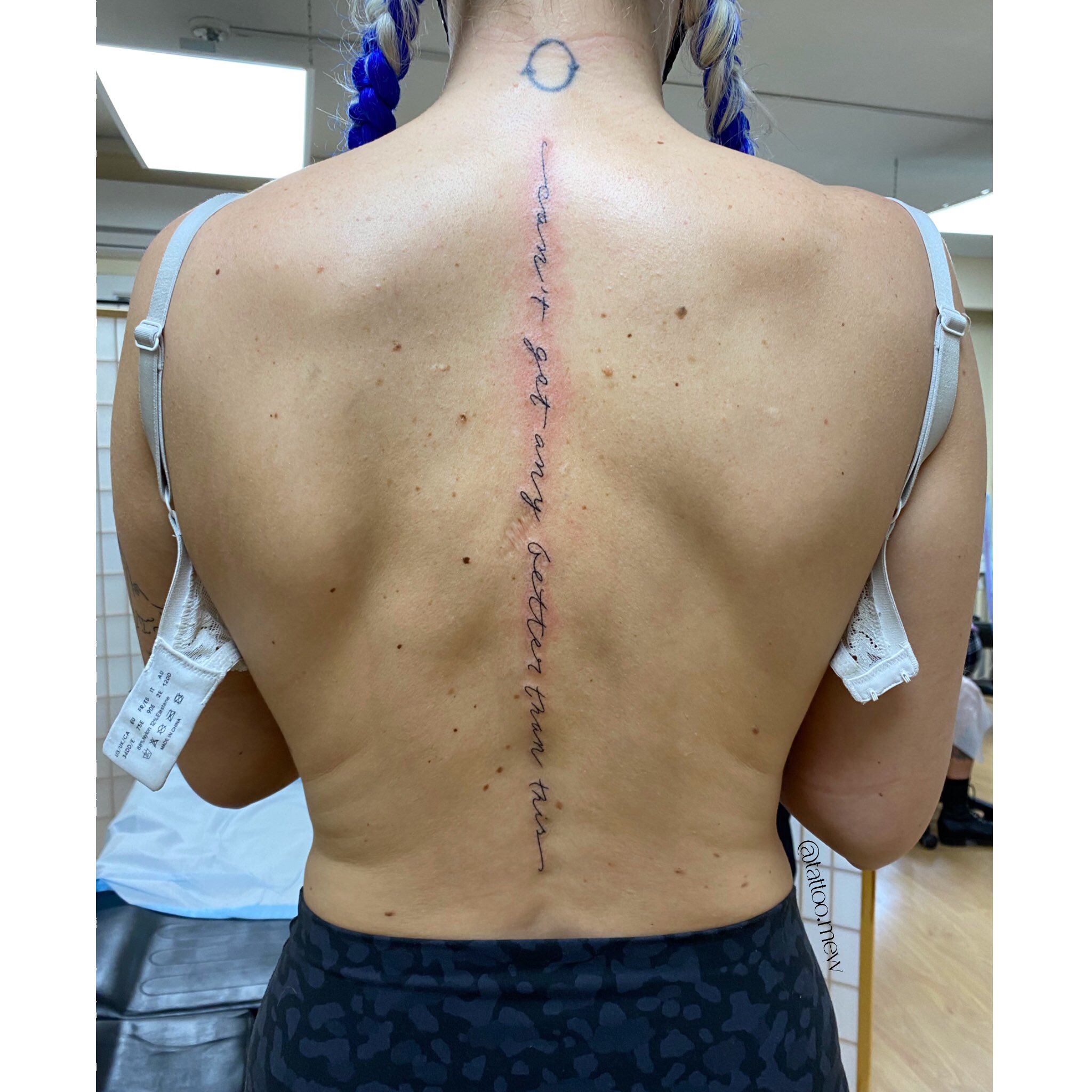 My backscars after having 2 back surgeries for scoliosis   rmildlyinteresting