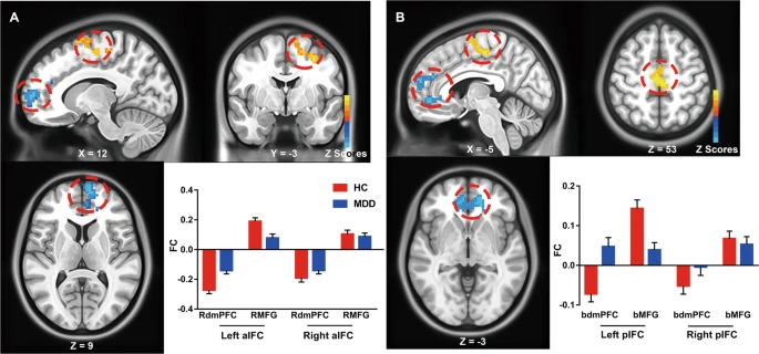 TranslationalPsychiatry (@transl_psych) on Twitter photo Insula network connectivity mediates the association between childhood maltreatment and depressive symptoms in major depressive disorder patients. By Cancan He et al.
#openaccess #depression #diagnosticmarkers
nature.com/articles/s4139… Insula network connectivity mediates the association between childhood maltreatment and depressive symptoms in major depressive disorder patients. By Cancan He et al.
#openaccess #depression #diagnosticmarkers
nature.com/articles/s4139…