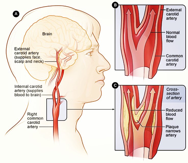 LifeStyle Screenings at the Vascular & Vein Center. We’ll screen for three of the leading silent killers. AAA, PAD and Carotid Artery Disease. #stroke #carotidarterydisease #stenosis #fortmyers #capecoral #bonitasprings