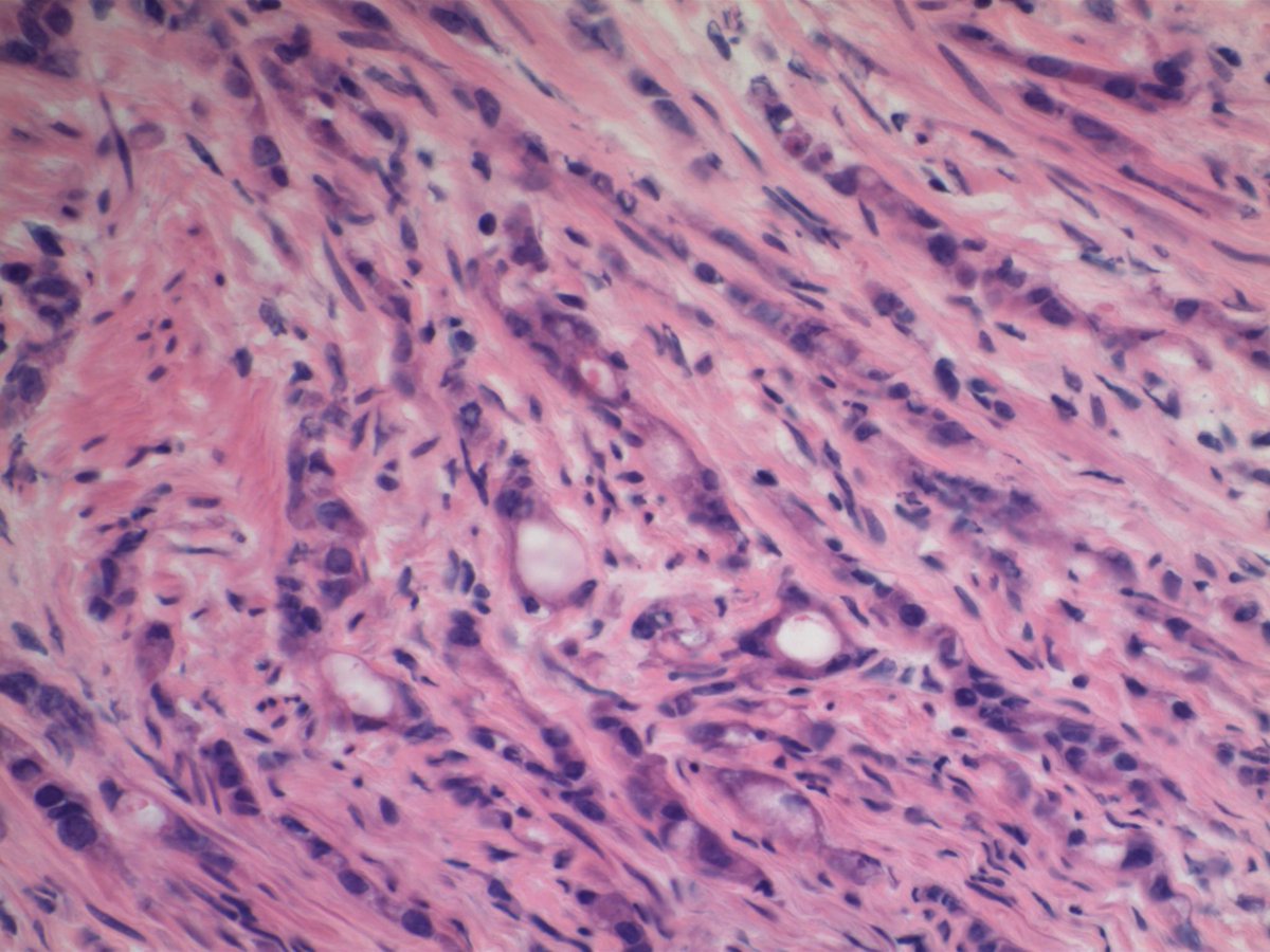 EKoubaMD's tweet photo. Carcinoma, favor metastatic. Surgeon runs stomach and bowel and finds large ulcerated cecal mass (CDX2 IHC shown). Final diagnosis, metastatic colon adenocarcinoma w/signet ring cell features (Krukenberg Tumor) #GYNpath #frozenpath https://t.co/EVfwUVxj4i