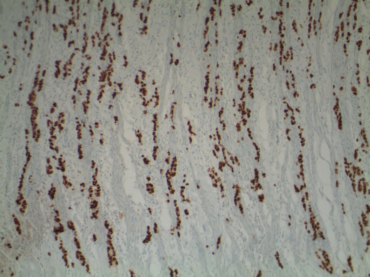 EKoubaMD's tweet photo. Carcinoma, favor metastatic. Surgeon runs stomach and bowel and finds large ulcerated cecal mass (CDX2 IHC shown). Final diagnosis, metastatic colon adenocarcinoma w/signet ring cell features (Krukenberg Tumor) #GYNpath #frozenpath https://t.co/EVfwUVxj4i