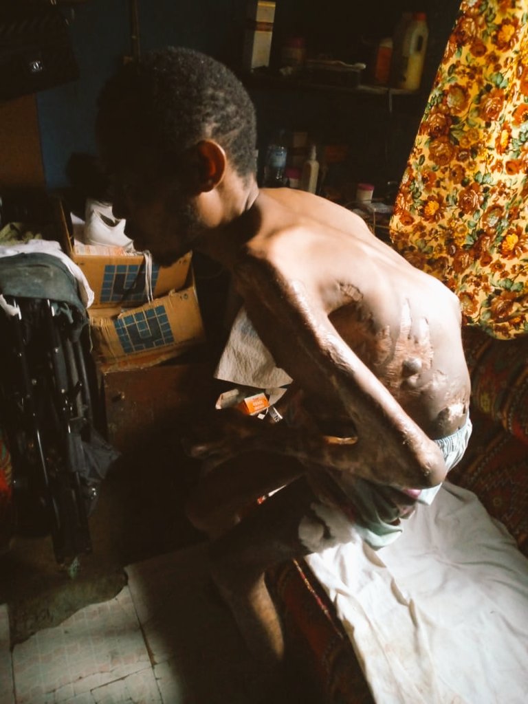 KaluKaris's tweet photo. @TemiOtedola Good morning TEMI OTEDOLA please I really need your help am a sickle cell anemia patient,am really sick &amp;need ur help I have been diagnosed of oestoemalitics of the right knee&amp; tobacolosis of the bone it's affected my spinal cord I can't walk anymore since 2011 
08139720887 https://t.co/JRwJbiaWUk