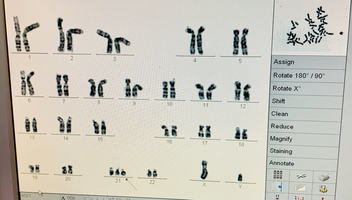 CgdBHU's tweet photo. At our Centre we perform karyotyping for cases referred from #SirSunderlalHospital for #DownSyndtome On #WorldDownSyndromeDay Our immense gratitude to our lab technicians of @cgdBHU @bhupro who assist in karyotyping Bajrangji and Indrabahadurji Here’s how it 👀 looks like #WDSD https://t.co/lRiDkPcNfG
