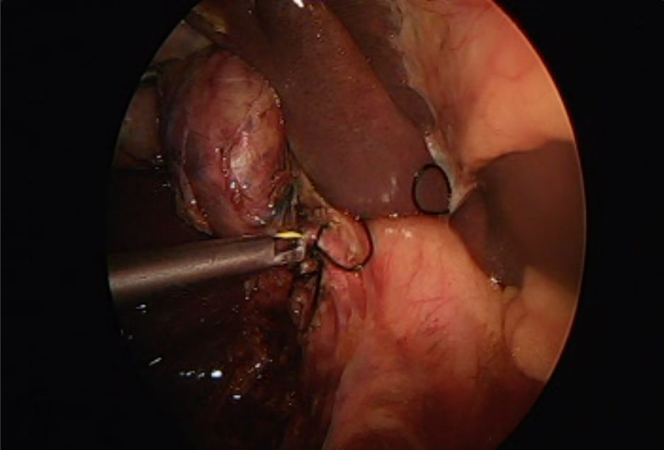 DrAdal_Pena's tweet photo. I get by with a little help from my friends. Coledocolitiasis. #MedTwitter #surgery #cirugiageneral #cpre Rendezvous #choledocolithiasis  #endoscopia @maely_gastro @ClinicaMexico https://t.co/fLpMcPWNSA