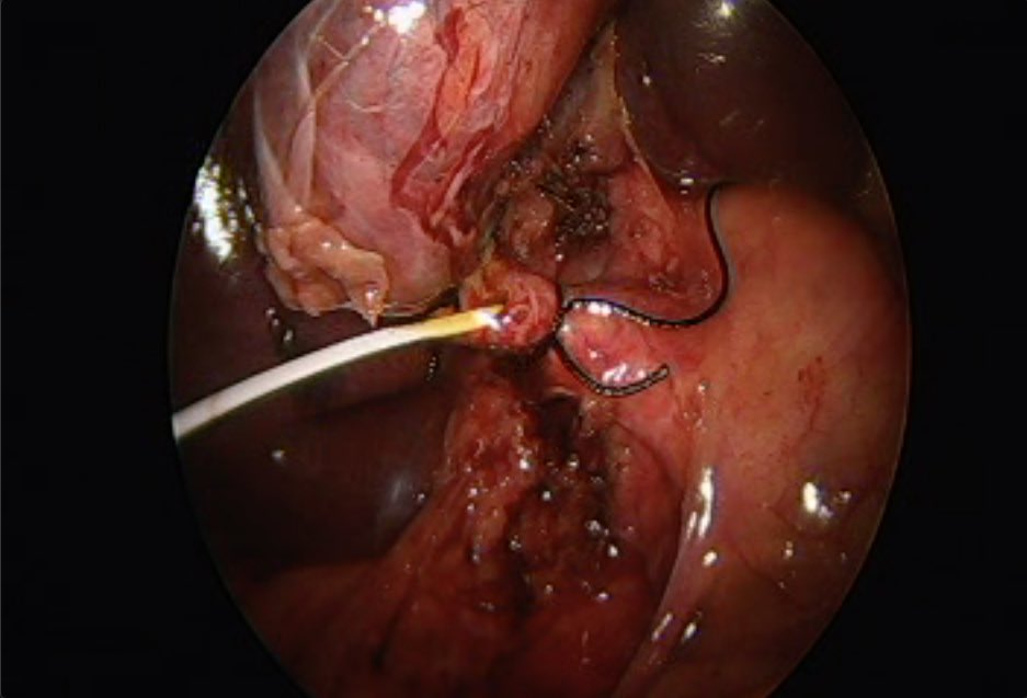 DrAdal_Pena's tweet photo. I get by with a little help from my friends. Coledocolitiasis. #MedTwitter #surgery #cirugiageneral #cpre Rendezvous #choledocolithiasis  #endoscopia @maely_gastro @ClinicaMexico https://t.co/fLpMcPWNSA
