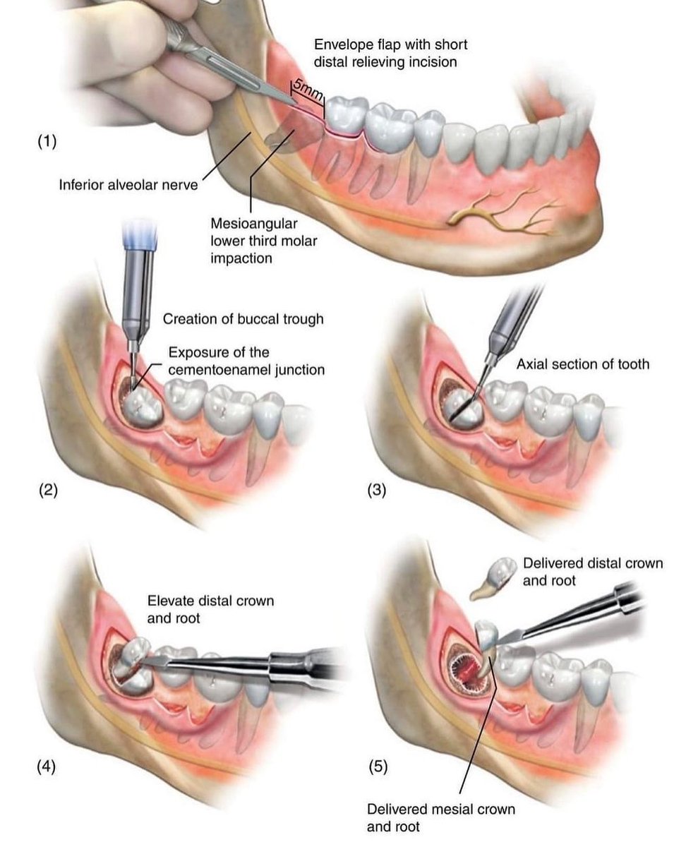 Dentagama's tweet photo. Steps in the removal of a mesioangular mandibular third molar https://t.co/DplTAESwgN