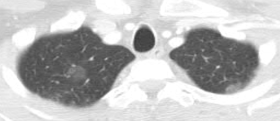 MayoPCCM's tweet photo. CXR and CT chest with #opacities in right upper lobe and bilateral lower lobes.
🤔 Anything else you would check? https://t.co/tY2SDOBGs7