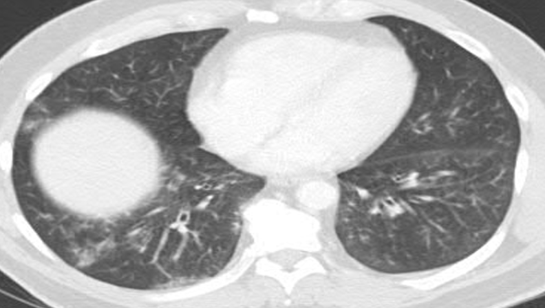 MayoPCCM's tweet photo. CXR and CT chest with #opacities in right upper lobe and bilateral lower lobes.
🤔 Anything else you would check? https://t.co/tY2SDOBGs7