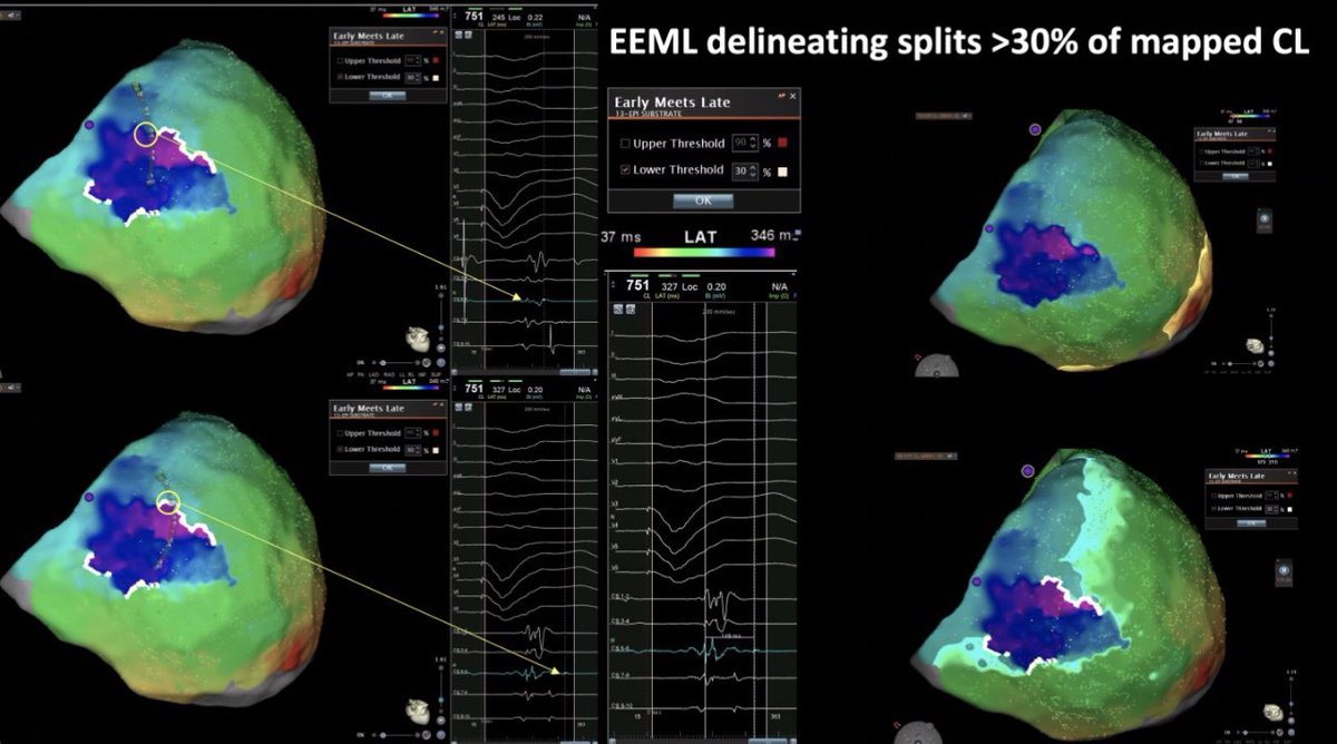 Pasquale Santangeli (@dr_santangeli) on Twitter photo Great <a href="/PennMedicine/">Penn Medicine</a> EP grand rounds with <a href="/Davilandre/">Andre dāAvila</a> - voltage independent substrate modification approach with no VT induction and same day discharge <a href="/PennEPFellows/">Penn Electrophysiology Fellowship</a> Great <a href="/PennMedicine/">Penn Medicine</a> EP grand rounds with <a href="/Davilandre/">Andre dāAvila</a> - voltage independent substrate modification approach with no VT induction and same day discharge <a href="/PennEPFellows/">Penn Electrophysiology Fellowship</a>