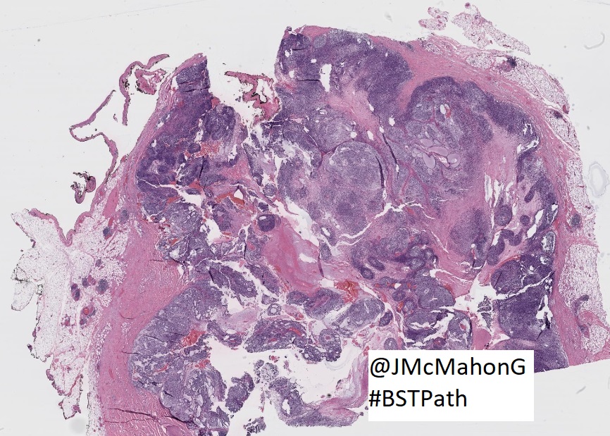 John Gross, MD (@jmcmahong) on Twitter photo <a href="/TheUSCAP/">USCAP</a> <a href="/reith16/">John Reith</a> <a href="/JMGardnerMD/">Jerad Gardner, MD</a> <a href="/NRiddleMD/">Nicole D. Riddle, MD, MSHI, FCAP (she/her)</a> <a href="/Vik_deshpandeMD/">Vikram Deshpande</a> <a href="/ScottBikeethan/">Scott Kilpatrick, MD</a> <a href="/GaryKeeneyMD/">Gary L. Keeney, M.D.</a> <a href="/FionaMacPath/">Fiona Maclean</a> <a href="/TristanRutland7/">Tristan Rutland MBBS FRCPA IFCAP</a> <a href="/MdSuster/">DavidSusterMD</a> @histiocytosisX One more low power pic from this case. Sneaky melanoma strikes again! #BSTPath101
Thanks again to everyone who interacted. Melanoma is always an important diagnostic consideration in soft tissue pathology and can assume a wide spectrum of morphologic patterns.
#USCAP2022 <a href="/TheUSCAP/">USCAP</a> <a href="/reith16/">John Reith</a> <a href="/JMGardnerMD/">Jerad Gardner, MD</a> <a href="/NRiddleMD/">Nicole D. Riddle, MD, MSHI, FCAP (she/her)</a> <a href="/Vik_deshpandeMD/">Vikram Deshpande</a> <a href="/ScottBikeethan/">Scott Kilpatrick, MD</a> <a href="/GaryKeeneyMD/">Gary L. Keeney, M.D.</a> <a href="/FionaMacPath/">Fiona Maclean</a> <a href="/TristanRutland7/">Tristan Rutland MBBS FRCPA IFCAP</a> <a href="/MdSuster/">DavidSusterMD</a> @histiocytosisX One more low power pic from this case. Sneaky melanoma strikes again! #BSTPath101
Thanks again to everyone who interacted. Melanoma is always an important diagnostic consideration in soft tissue pathology and can assume a wide spectrum of morphologic patterns.
#USCAP2022