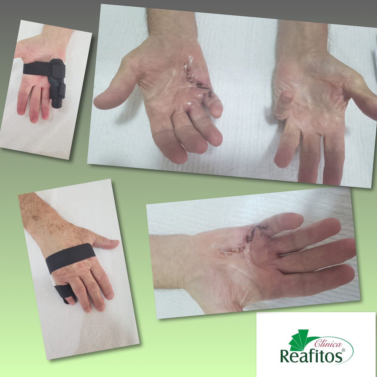 Pós Operatório de Contratura ou Moléstia de Dupuytren
Esta contratura ocorre devido a um endurecimento progressivo nas palmas das mãos, podendo levar a flexão dos dedos e posteriormente em garra, e costuma afetar os 4º e 5º dedos (anelar e mínimo), podendo vir acometer mais dedos