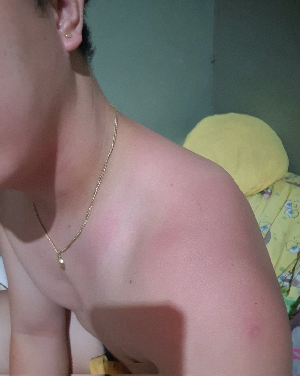j0ckstr's tweet photo. sun burnt
pakipahidan naman ng lotion
🤣😂 https://t.co/WIIglrvKK9