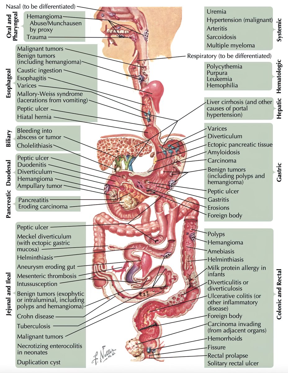 Causes of GI bleeding 🩸#4KMedEd #GITwitter

(Courtesy of Netter's)
