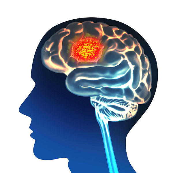 ISRCTN's tweet photo. Progesterone as a steroid-sparing agent against oedema occurring with secondary brain cancers

Read about the @ProssperTrial registered at the #ISRCTN registry

https://t.co/LqHYDslsh0 https://t.co/67PI69TwVT