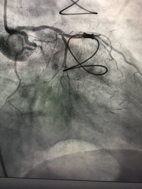 KeithNguyenSAIF's tweet photo. CTO intervention lcx. @SAIFSanAntonio https://t.co/ZQJ7s3PGlB