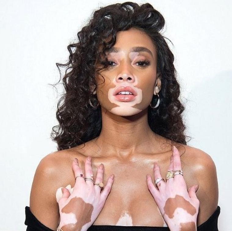 aku_mbg's tweet photo. #vitiligo Ciltte beyaz lekeler, yamalar şeklinde kendini belli eden otoimmün,genetik ve çevresel faktörlerden etkilenen bir hastalıktır. Halk arasında alaca denir. Otoimmün hastalıklar,bağışıklık sisteminin kendi hücrelerini düşman gibi algılayıp saldırması sonucu oluşmaktadır. https://t.co/lv3ORqK2CO