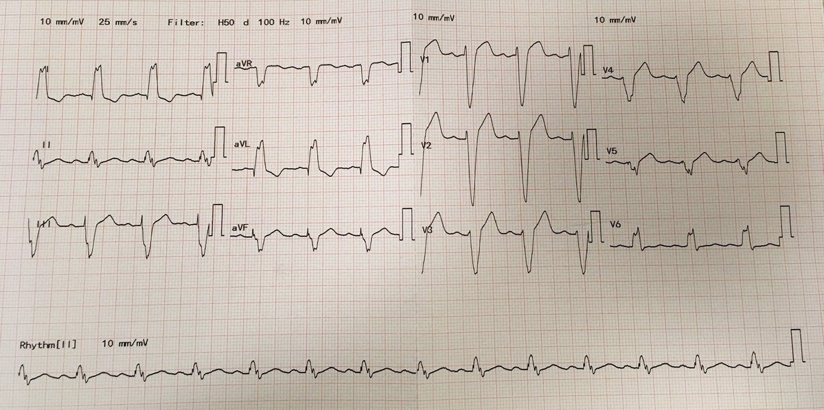CTFLeics's tweet photo. If the ☀️ wasn’t enough, here’s an ECG on #Cardio Mondays @LeMedSchool to kick-start your week! What’s your interpretation? 🔍 Poll ⬇️ #MedEd https://t.co/SHKordTfbf
