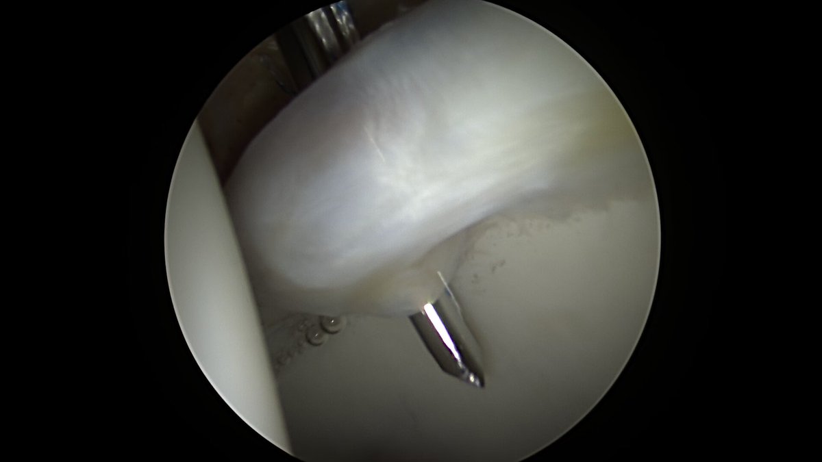 CzarneckiMD's tweet photo. Most hip labral tears (>90%) occur in association with impingement. The other 10% tend to come from microinstability or trauma. Once we repair the torn labrum, we also close the capsule & imbricate it with plication as needed if micro instability exists #hipscope #hiplabralrepair https://t.co/ZqZsamqICC