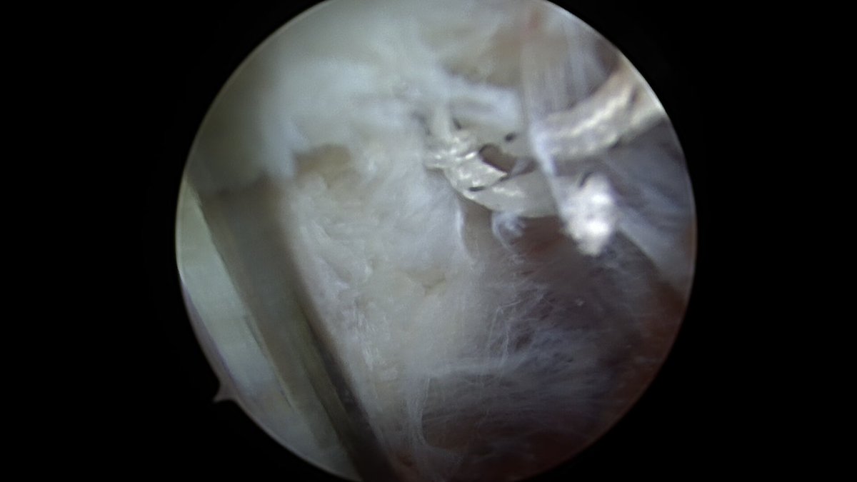 CzarneckiMD's tweet photo. Most hip labral tears (>90%) occur in association with impingement. The other 10% tend to come from microinstability or trauma. Once we repair the torn labrum, we also close the capsule & imbricate it with plication as needed if micro instability exists #hipscope #hiplabralrepair https://t.co/ZqZsamqICC