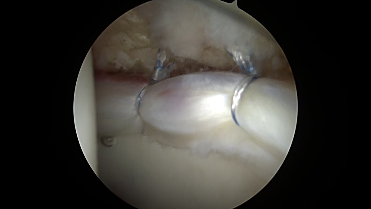 CzarneckiMD's tweet photo. Most hip labral tears (>90%) occur in association with impingement. The other 10% tend to come from microinstability or trauma. Once we repair the torn labrum, we also close the capsule & imbricate it with plication as needed if micro instability exists #hipscope #hiplabralrepair https://t.co/ZqZsamqICC