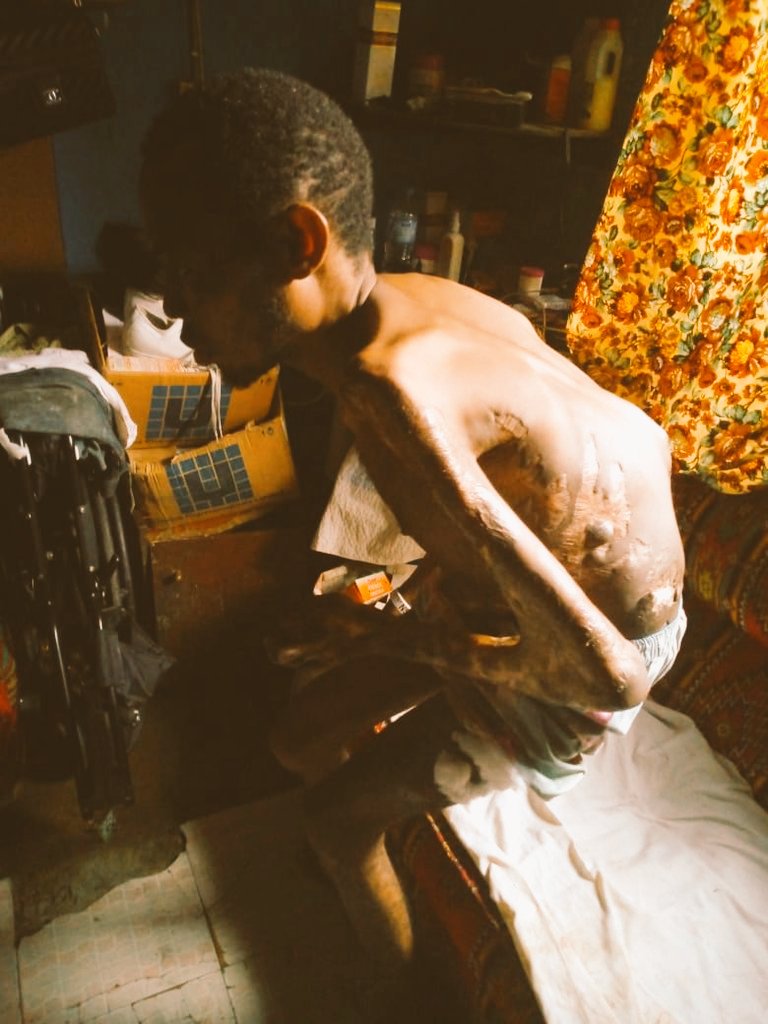 KaluKaris's tweet photo. @jidesanwoolu Good morning Sterling bank please I really need your help am a sickle cell anemia patient,am really sick &amp;need ur help I have been diagnosed of oestoemalitics of the right knee&amp; tobacolosis of the bone it's affected my spinal cord I can't walk anymore since 2011 https://t.co/HAL8MvcH3F