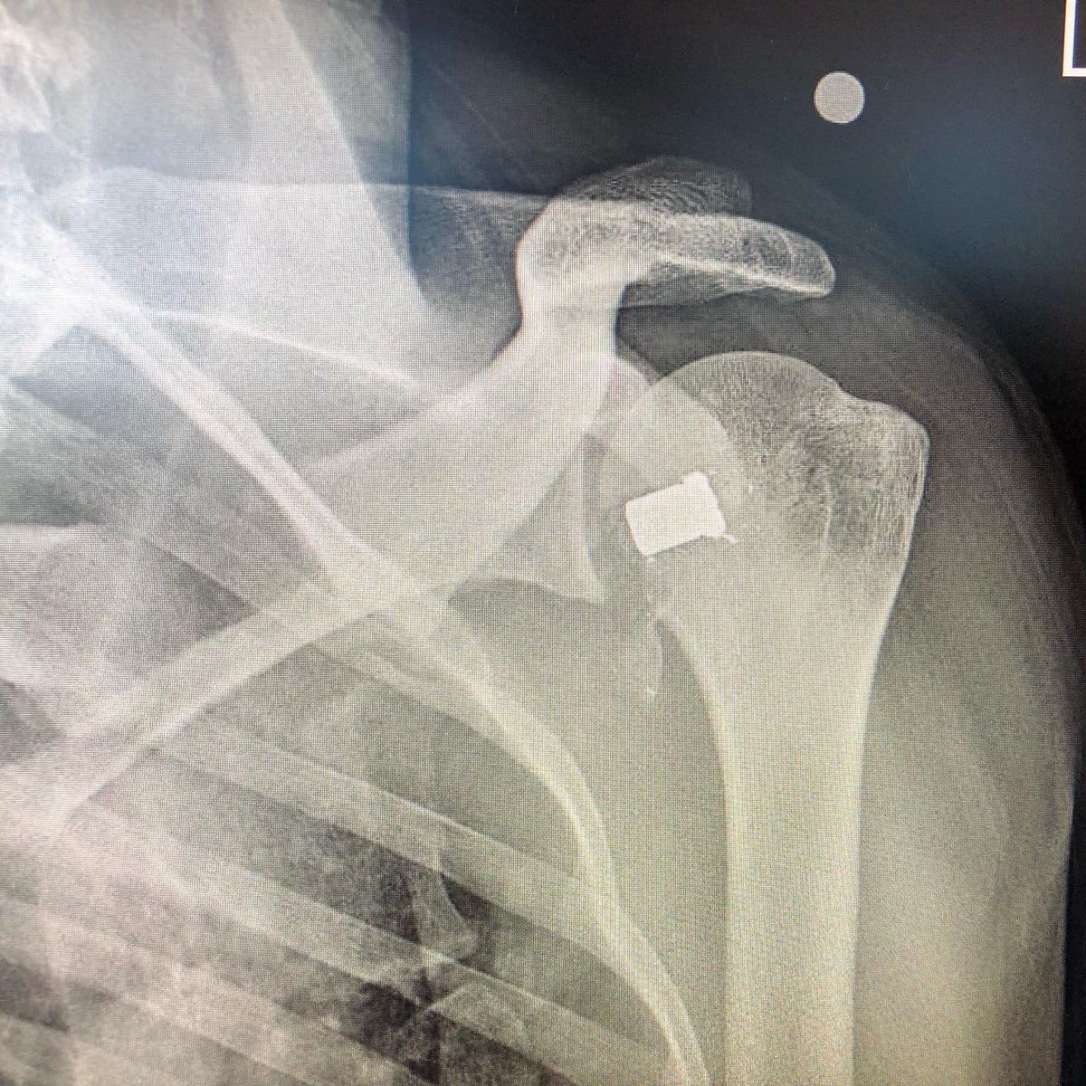 ChrisCookeMD's tweet photo. @NuelleSportsMD Took this out arthroscopically. 
Metal pan was ready. https://t.co/NDBSTySYG4