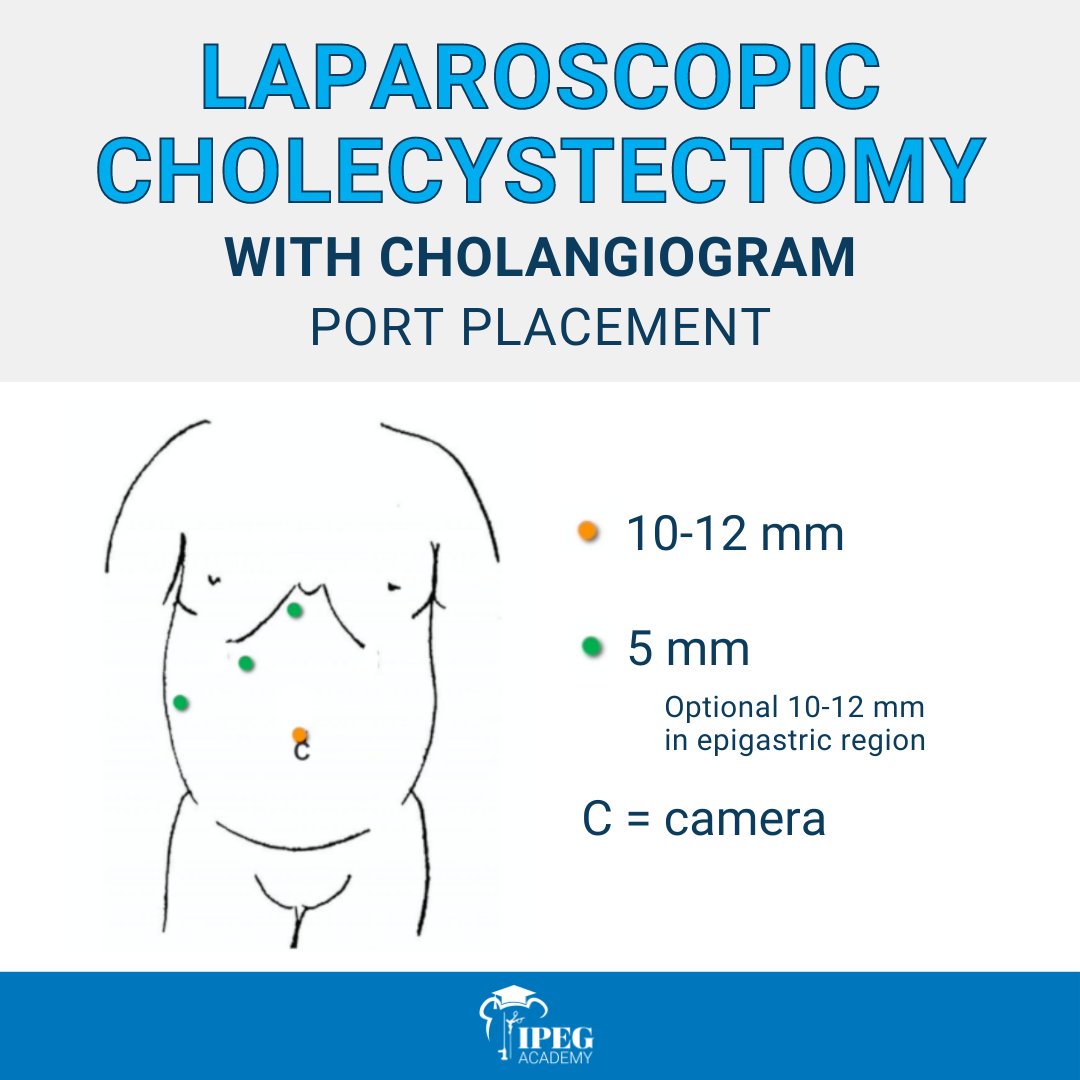 IPEG on X: Here is the port placement for a laparoscopic cholecystectomy  with cholangiogram! Did you know that all of our #IPEGAcademy instructional  videos include diagrams for the port placement? You can